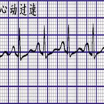 窦性心动过速是什么意思,成因、症状与防治策略