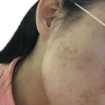 光子嫩肤的功效与副作用,美丽肌肤的利与弊全面解析